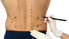  ZAJDĚTE SI NA LIPOSUKCI V LÉTĚ A ZÍSKEJTE SLEVU 20 %! - foto 4 | brand photo