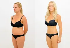  ZAJDĚTE SI NA LIPOSUKCI V LÉTĚ A ZÍSKEJTE SLEVU 20 %! - foto 2 | brand photo